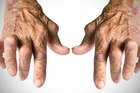 Artrite e Artrosi: quali sono le differenze?